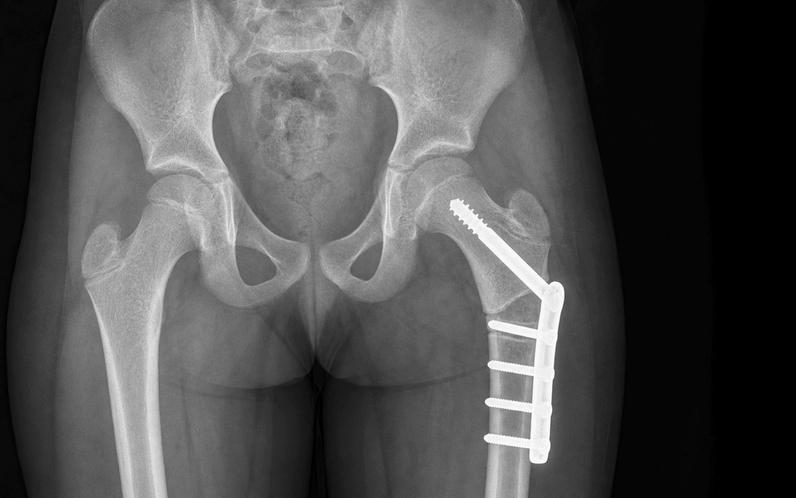 AP hip radiograph after a femoral varus derotation osteotomy