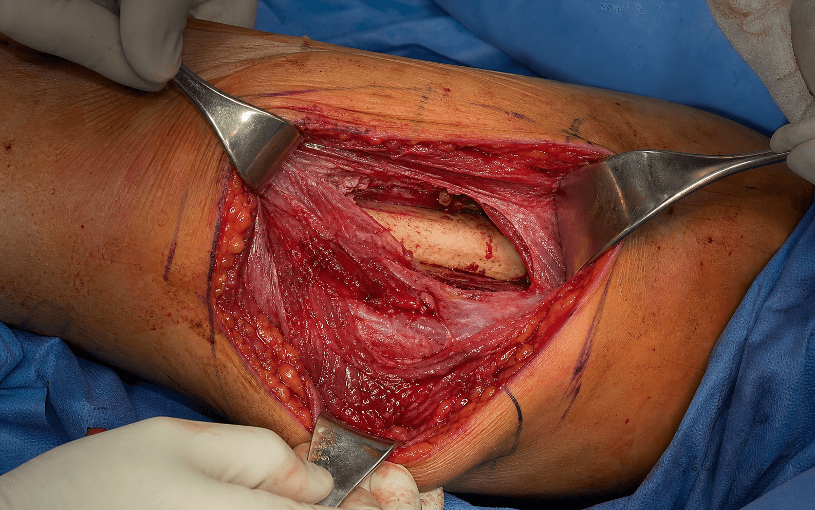 Anteromedial femoral approach