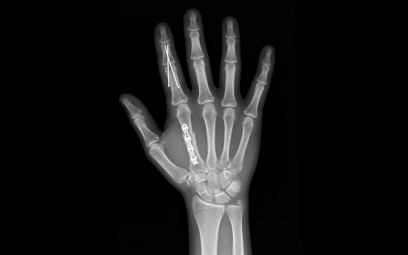 Hand radiograph after internal fixation of a finger fracture