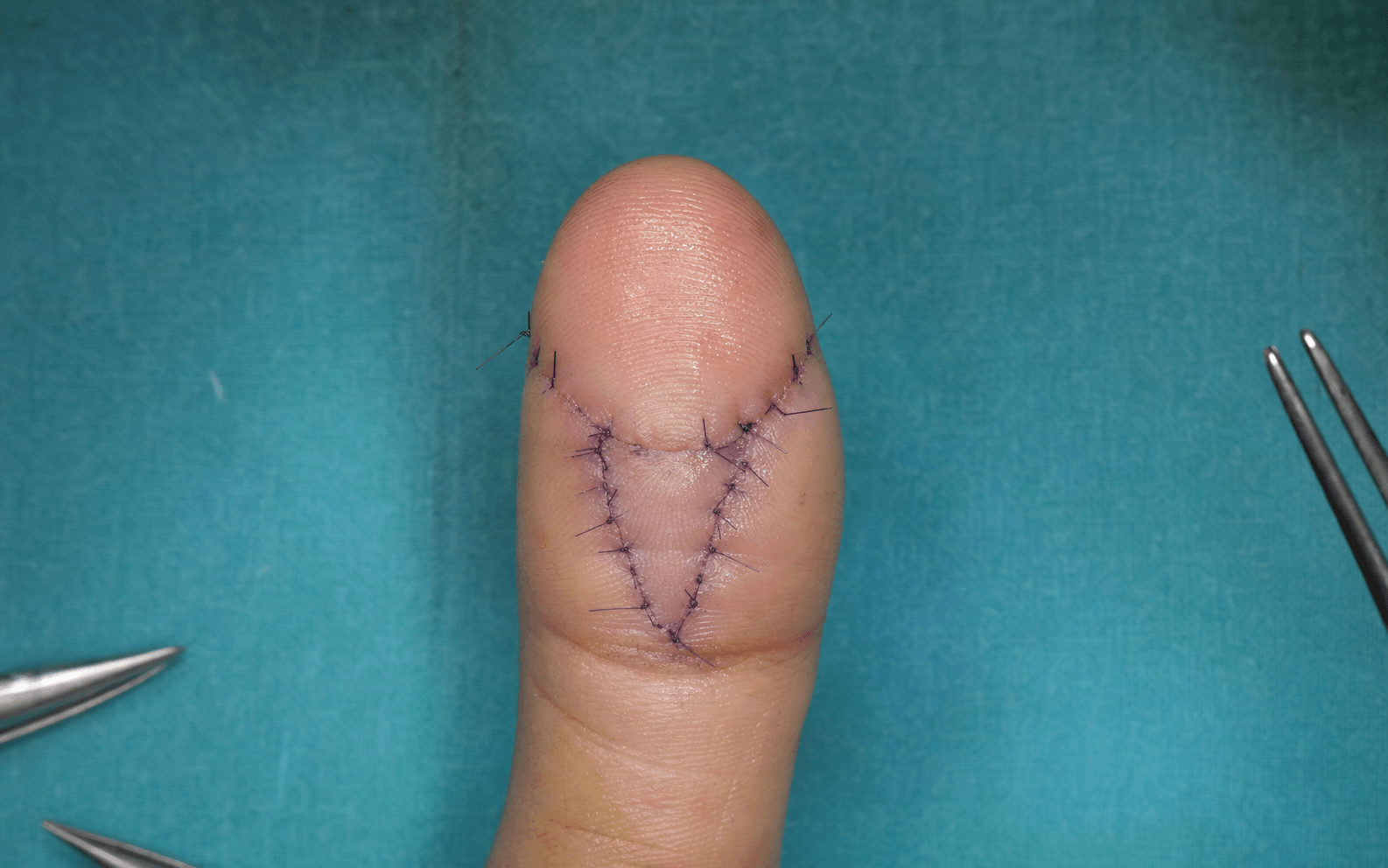 Fingertip amputation flap reconstruction
