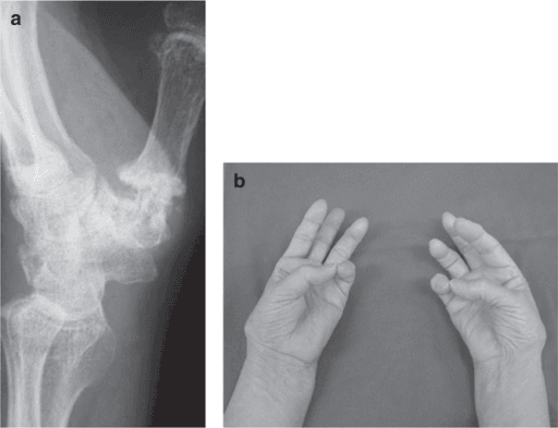 Radiograph and clinical photograph of advanced basal thumb osteoarthritis