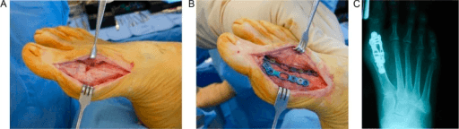 Three-panel first MTP joint arthrodesis showing open joint A plate fixation B and post-op foot X-ray C