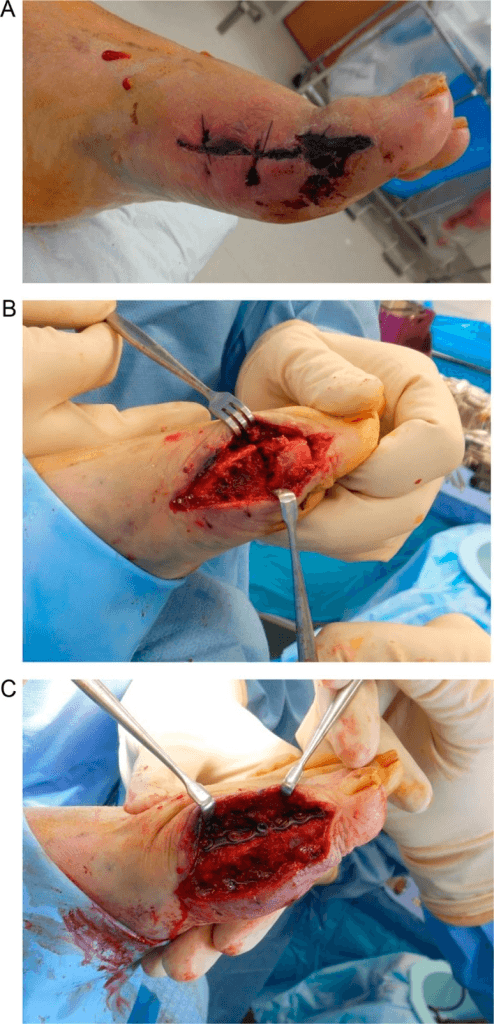 Three-panel intraoperative series showing wound closure and joint preparation for first MTPJ arthrodesis