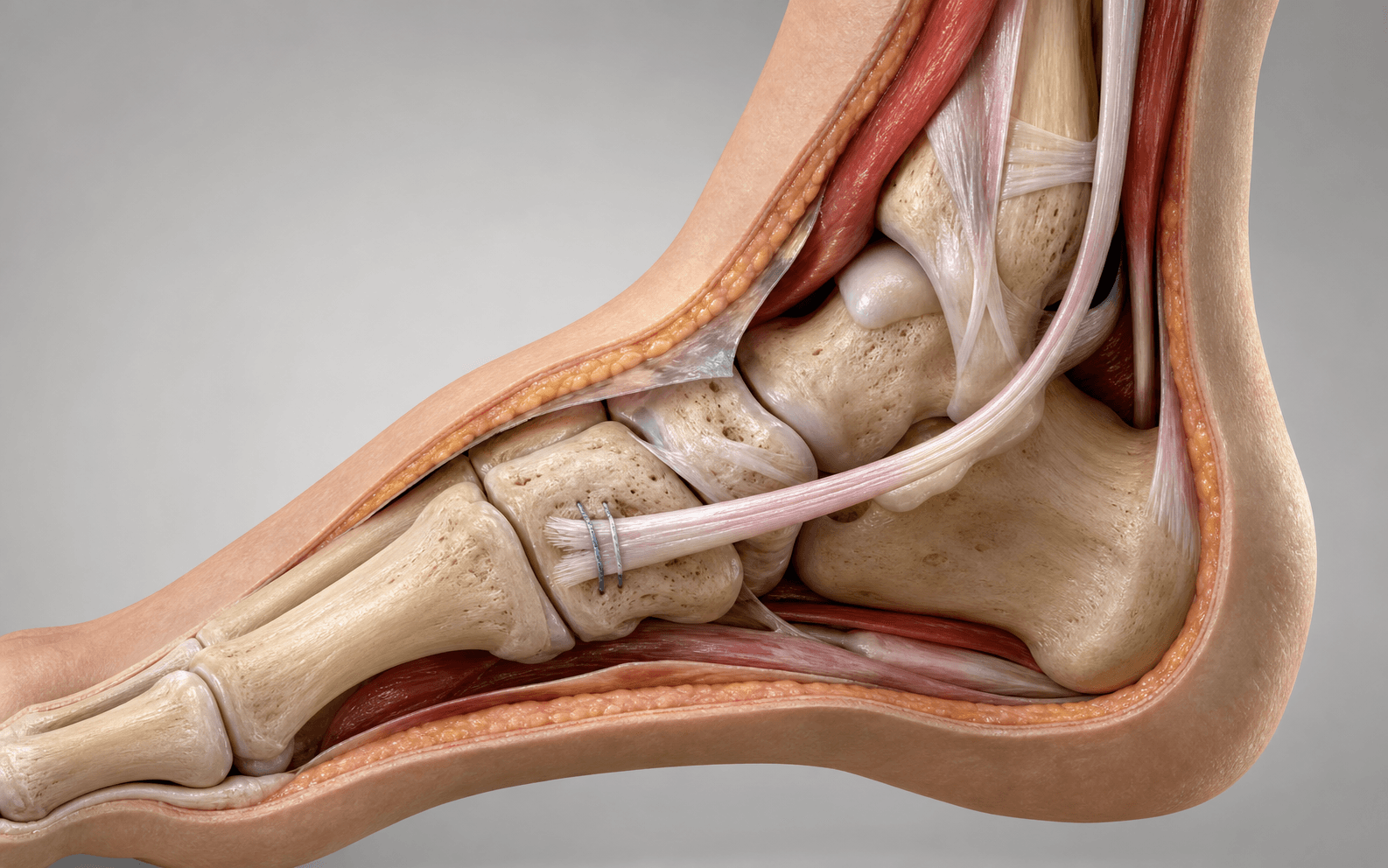 FDL tendon along medial foot