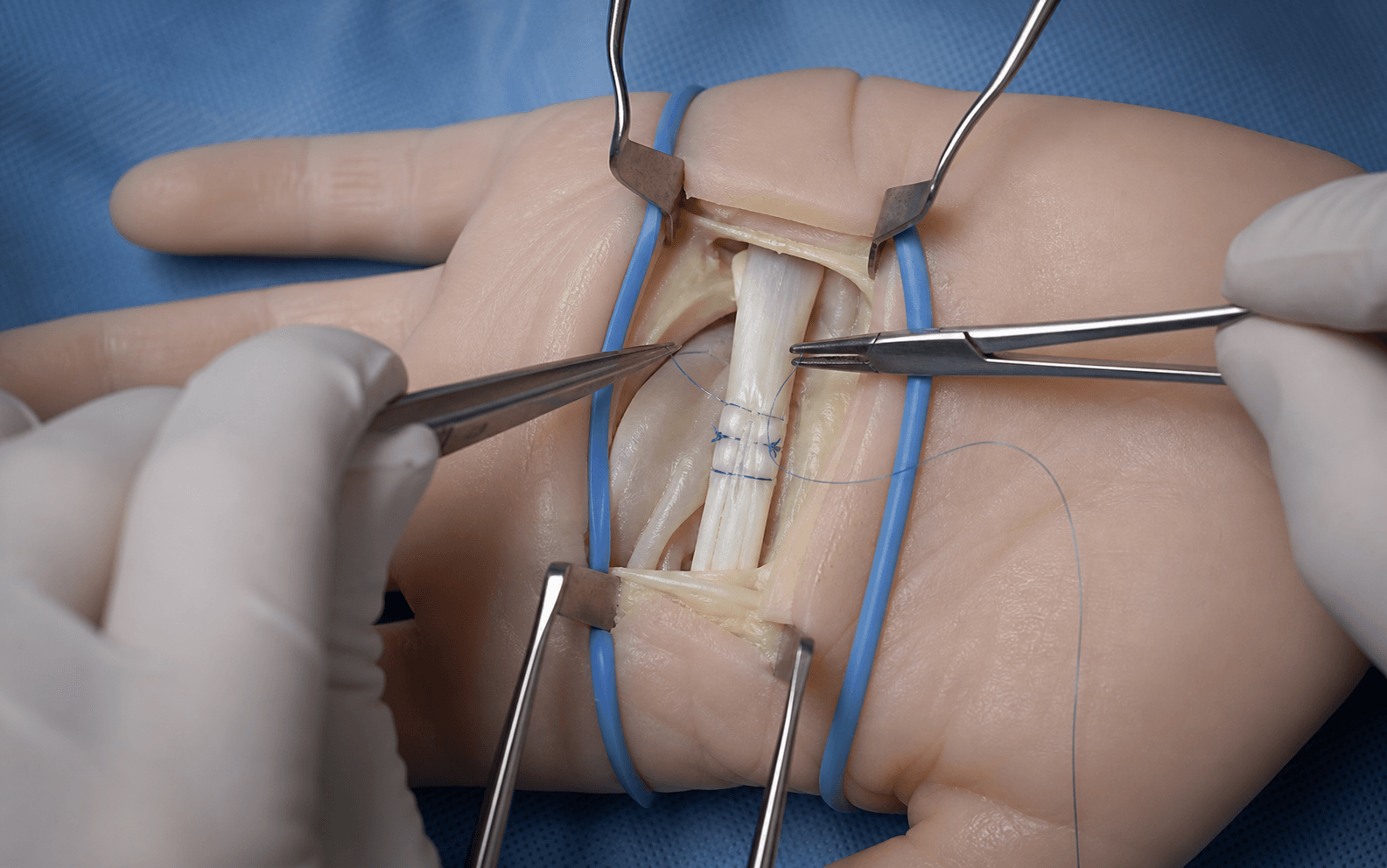 Flexor tendon repair