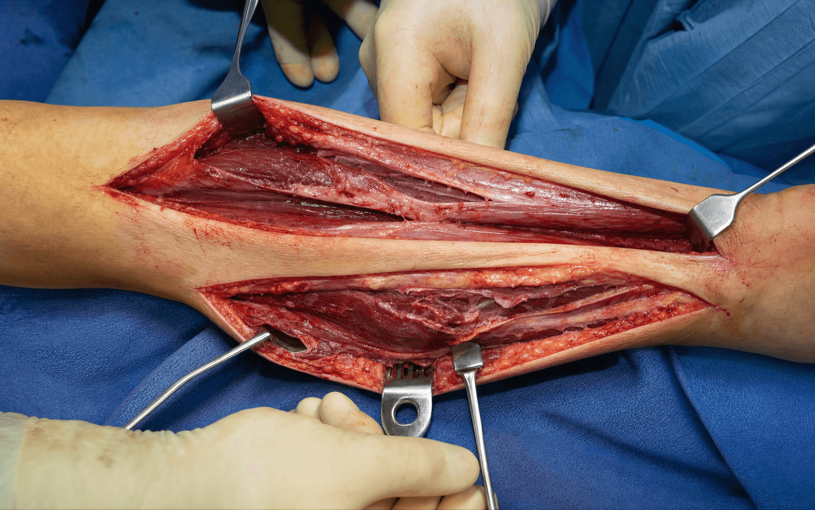 Forearm fasciotomy