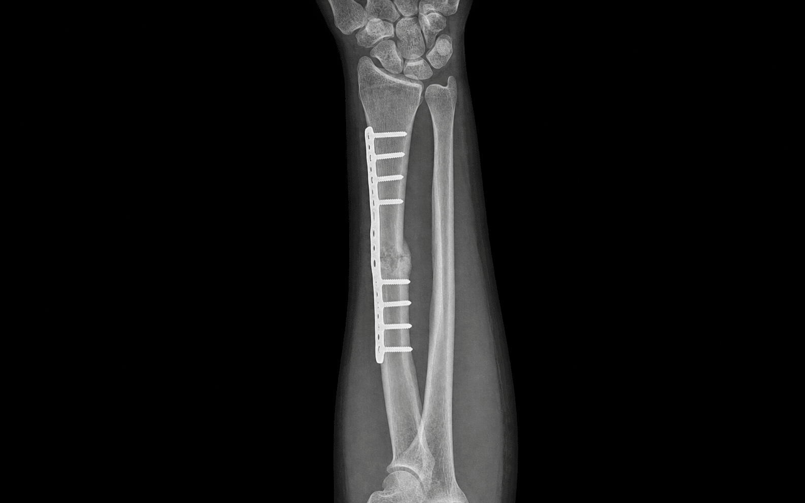 Galeazzi fracture ORIF