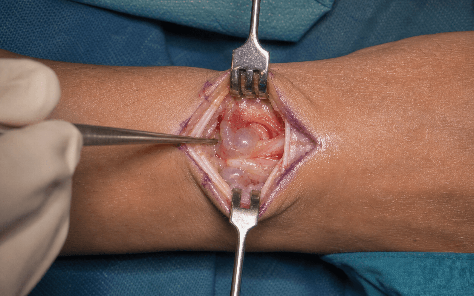 Dorsal wrist ganglion excision