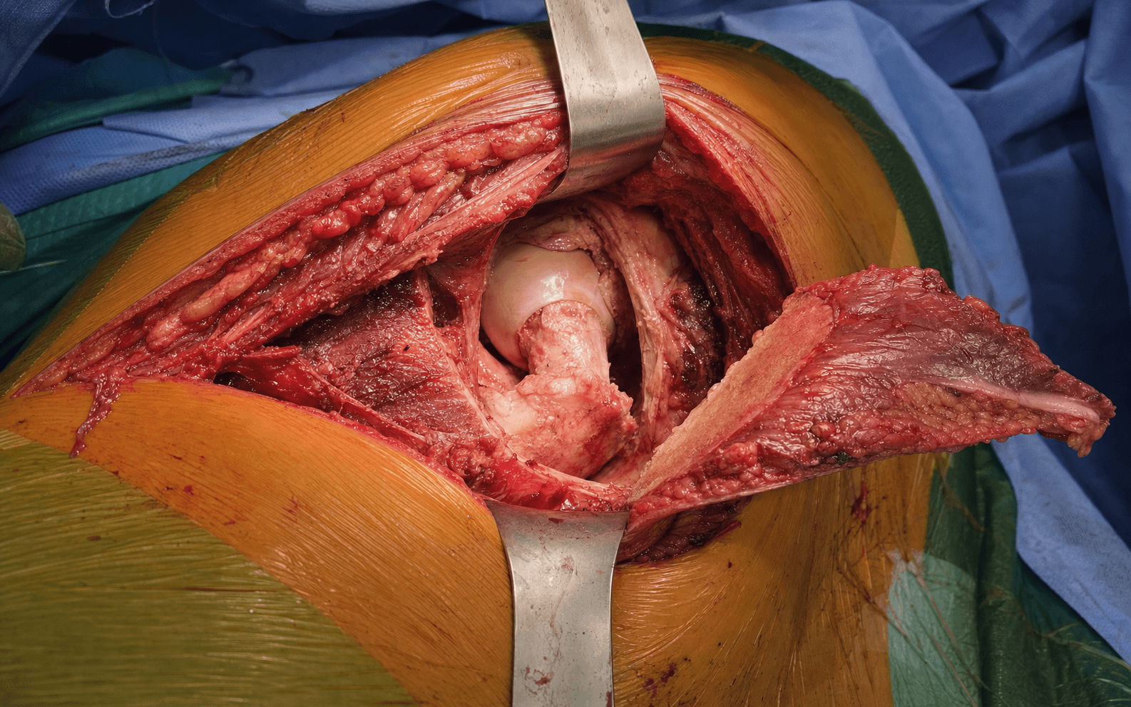 Ganz surgical hip dislocation