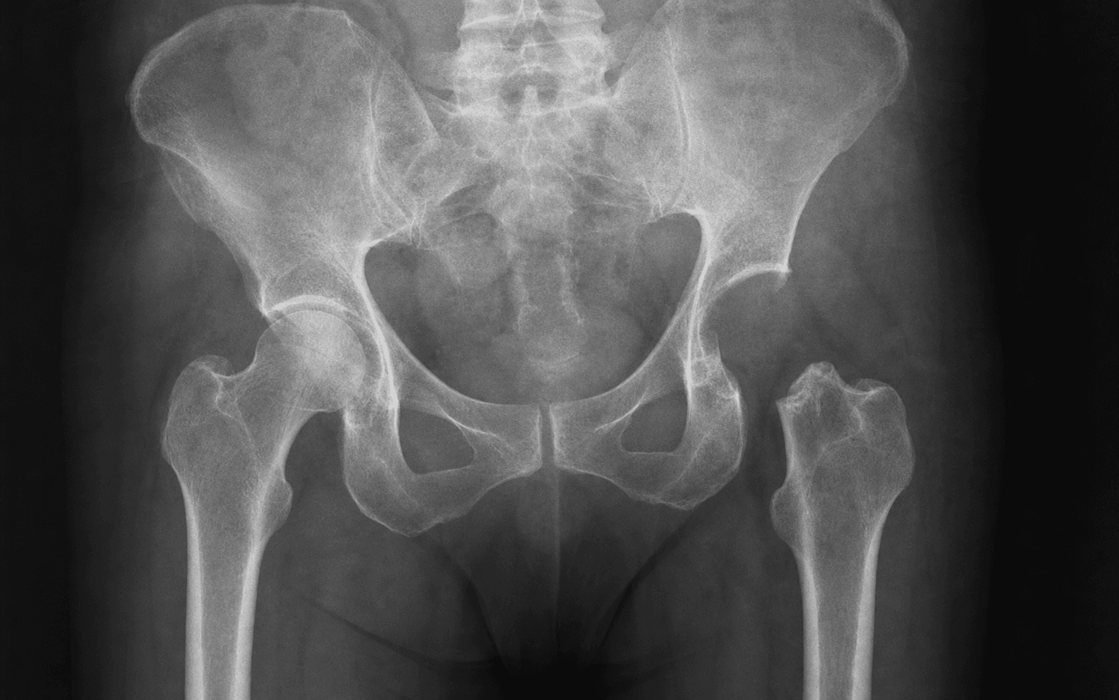 Girdlestone resection arthroplasty