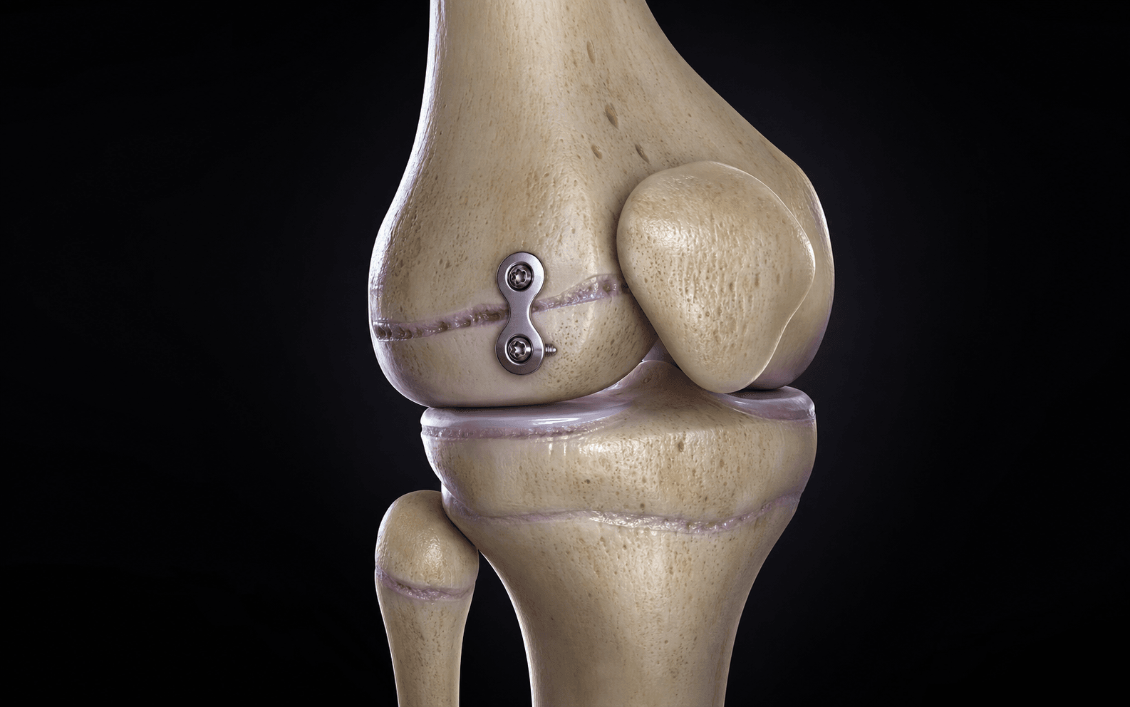Render of a guided-growth tension-band plate at the knee
