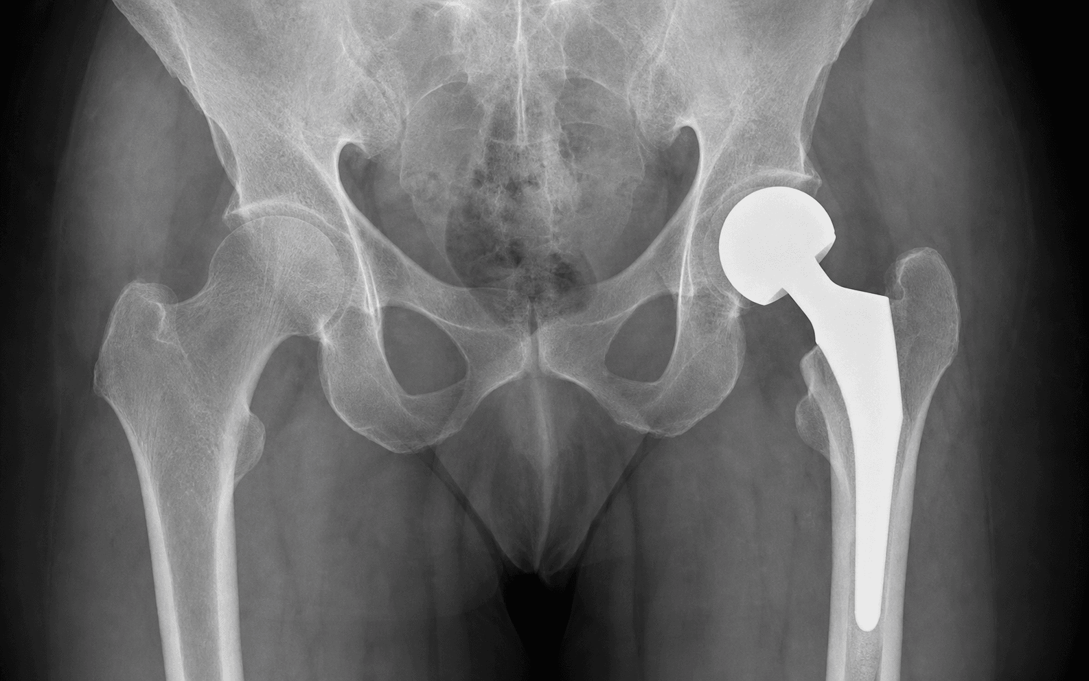 Hip hemiarthroplasty