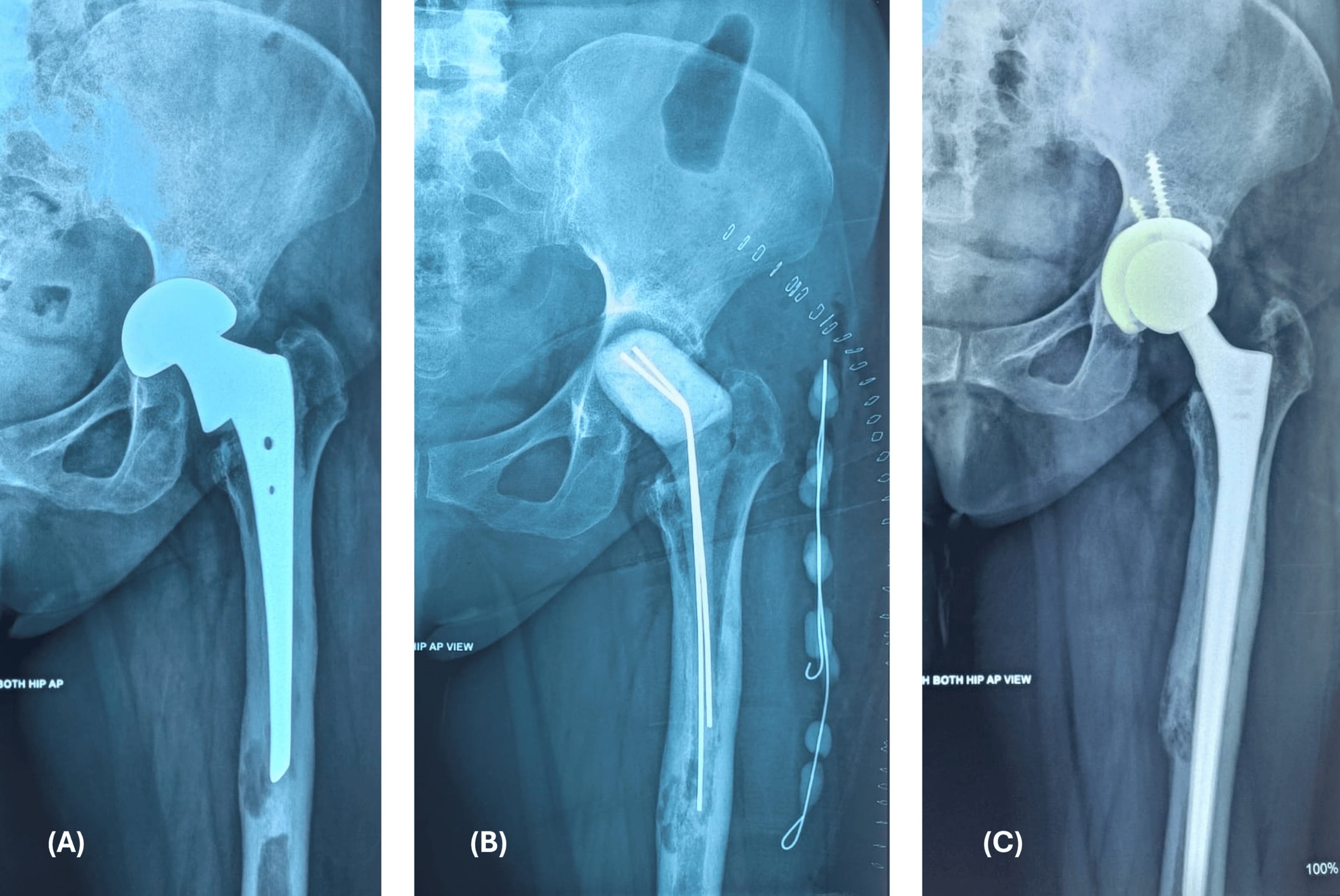 AP radiographs of a hip in three panels: an infected uncemented hemiarthroplasty with acetabular erosion, an antibiotic cement spacer, and a revision total hip replacement