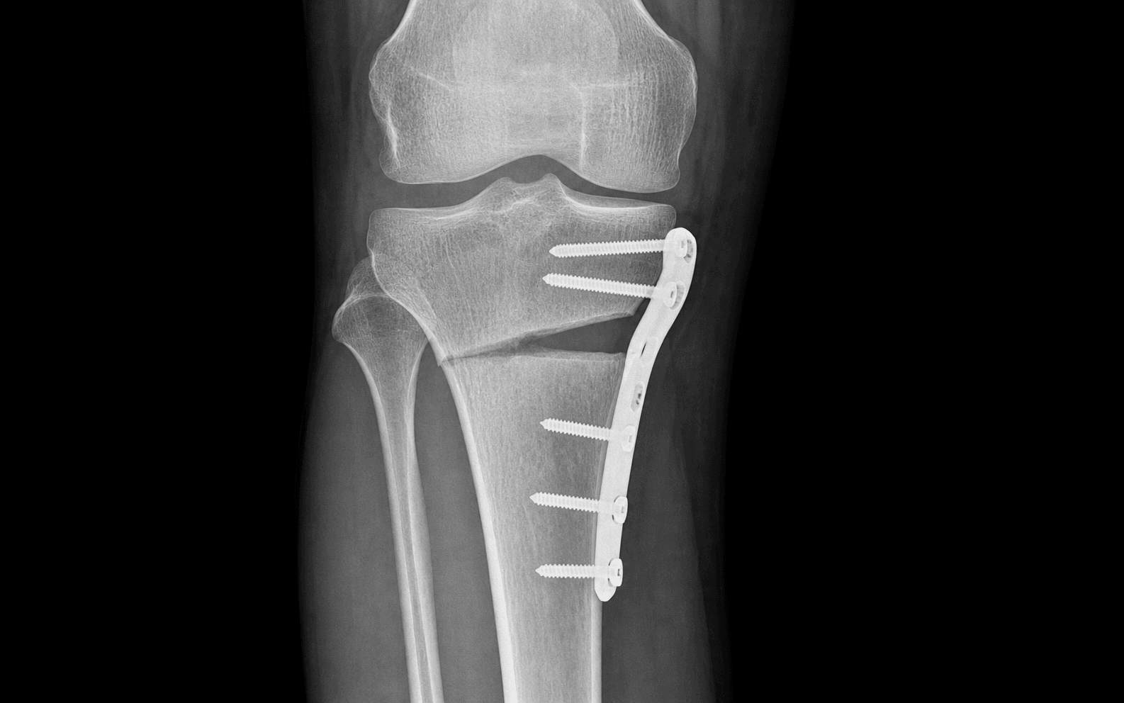 AP knee radiograph after a high tibial osteotomy
