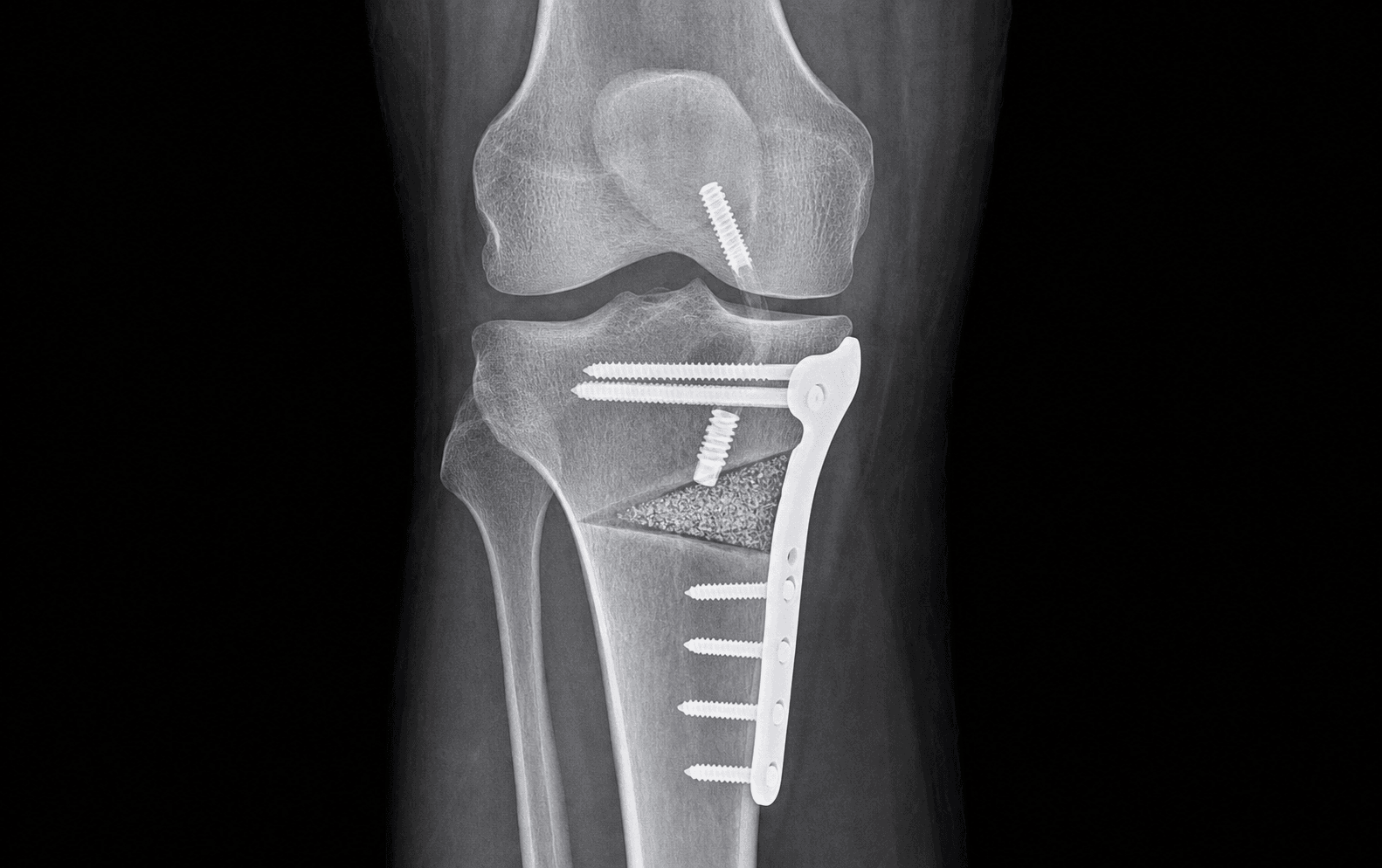 HTO with ACL reconstruction