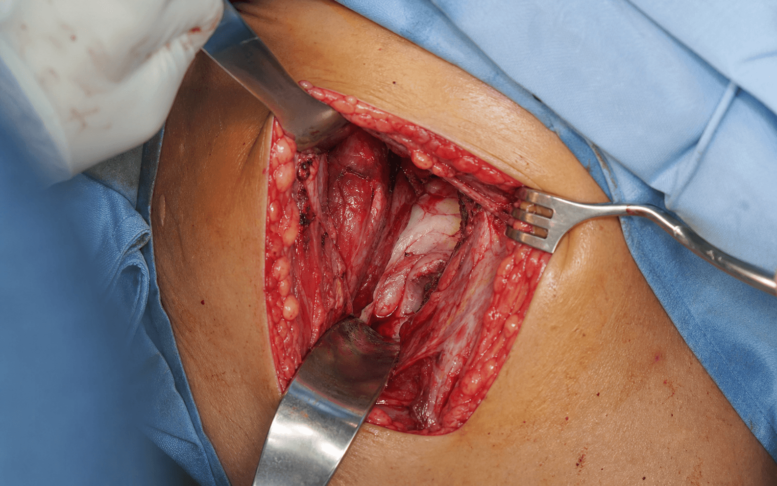 Intra-operative Smith-Petersen anterior approach to the hip