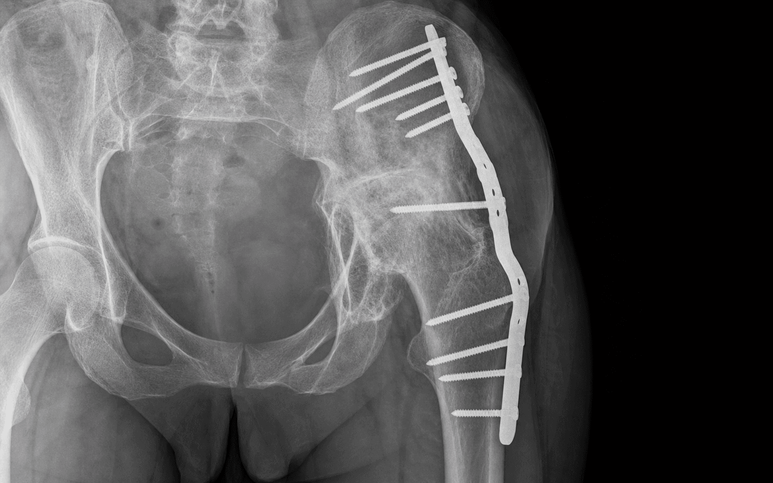 Hip arthrodesis