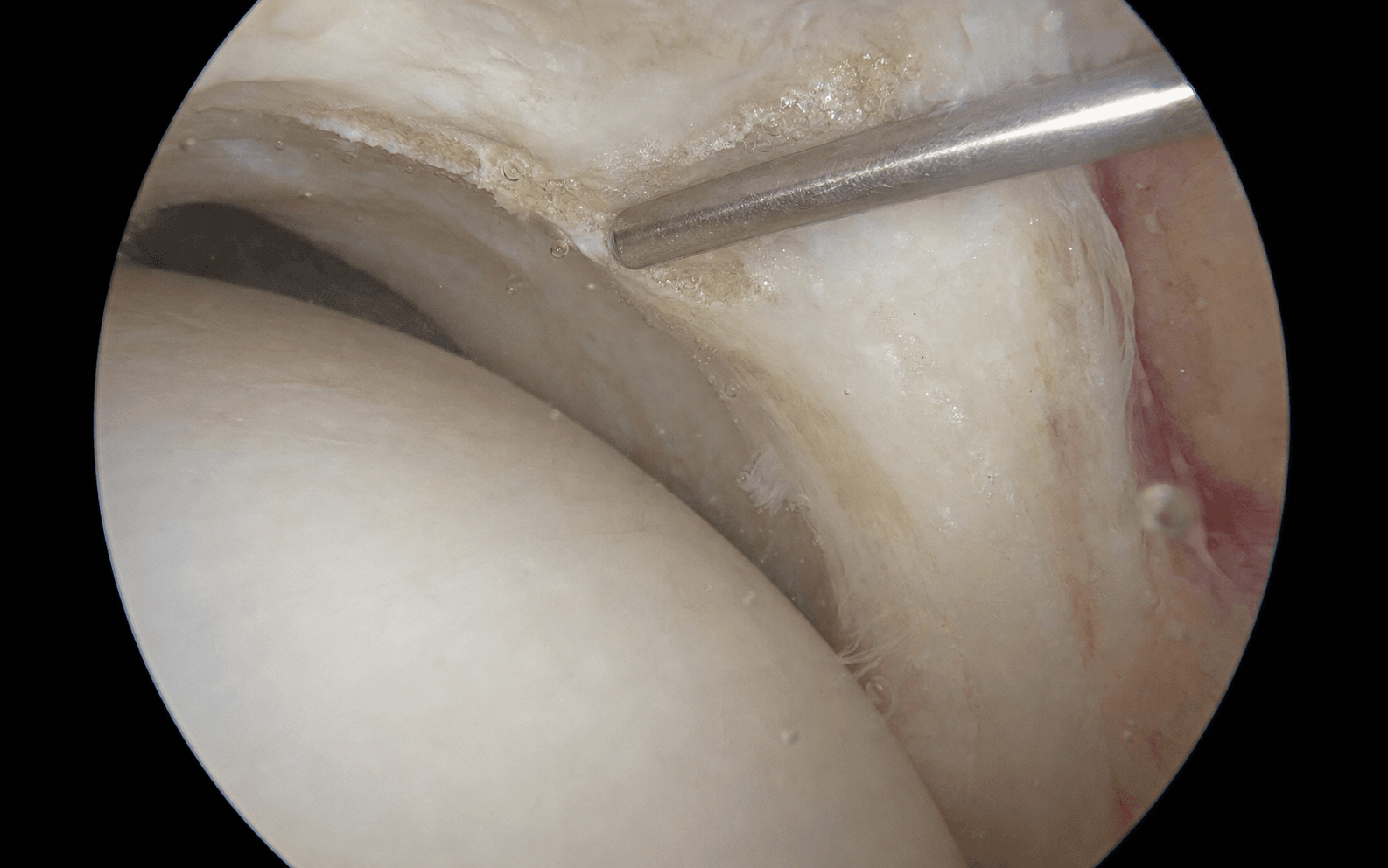 Hip arthroscopy for FAI