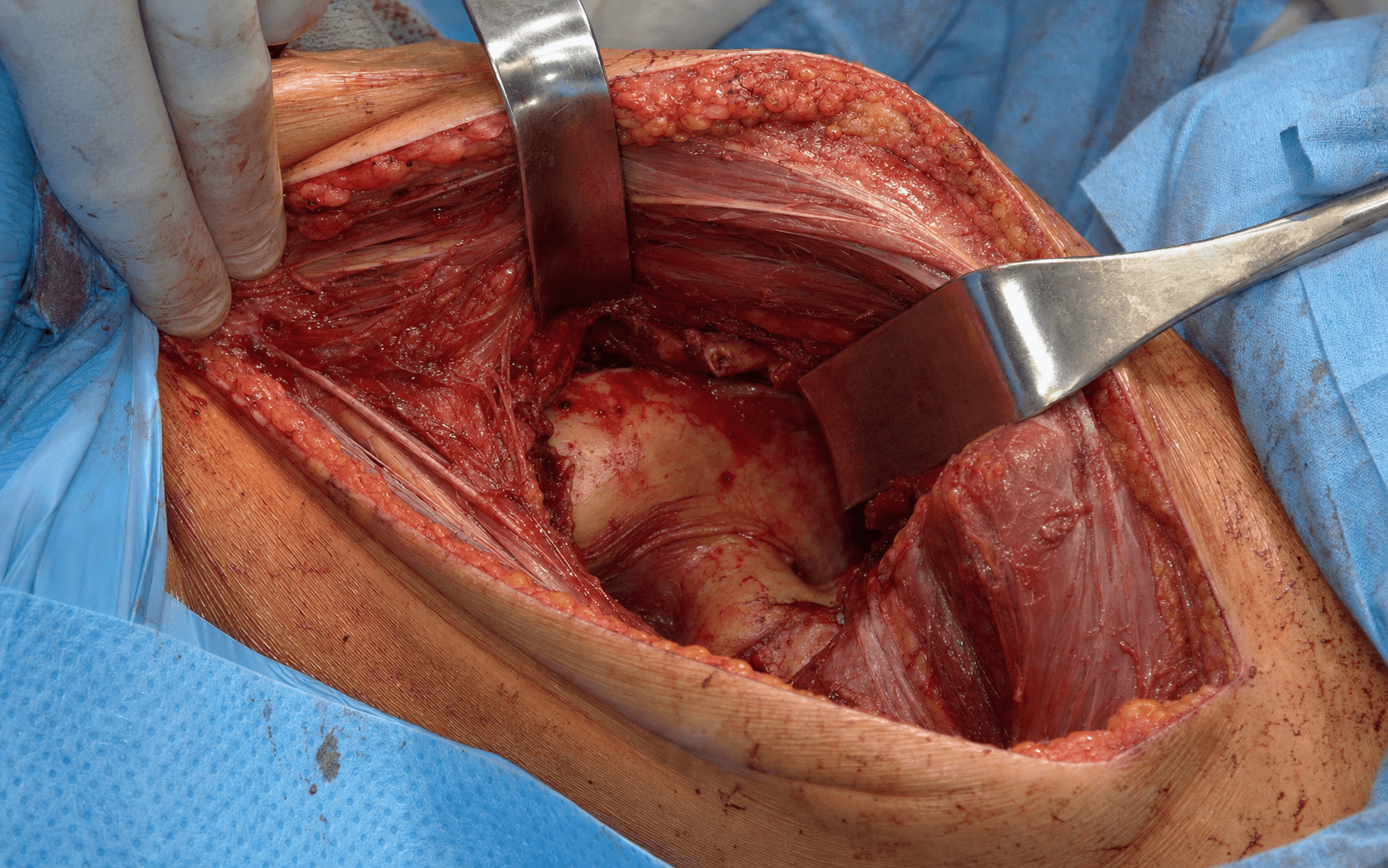 Hardinge direct lateral approach
