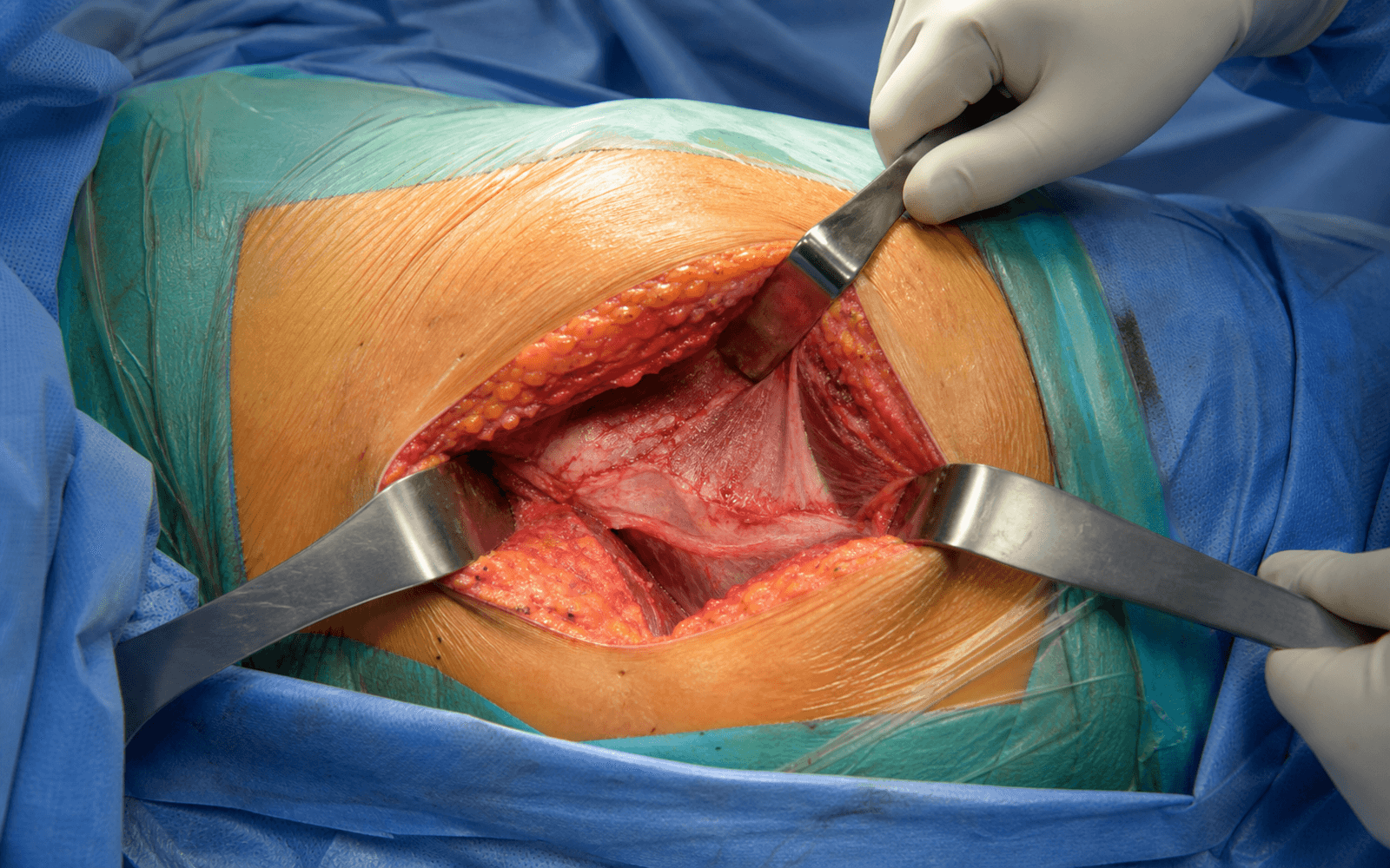 Posterior hip approach