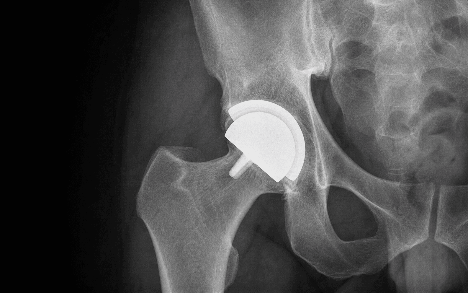 Hip resurfacing arthroplasty