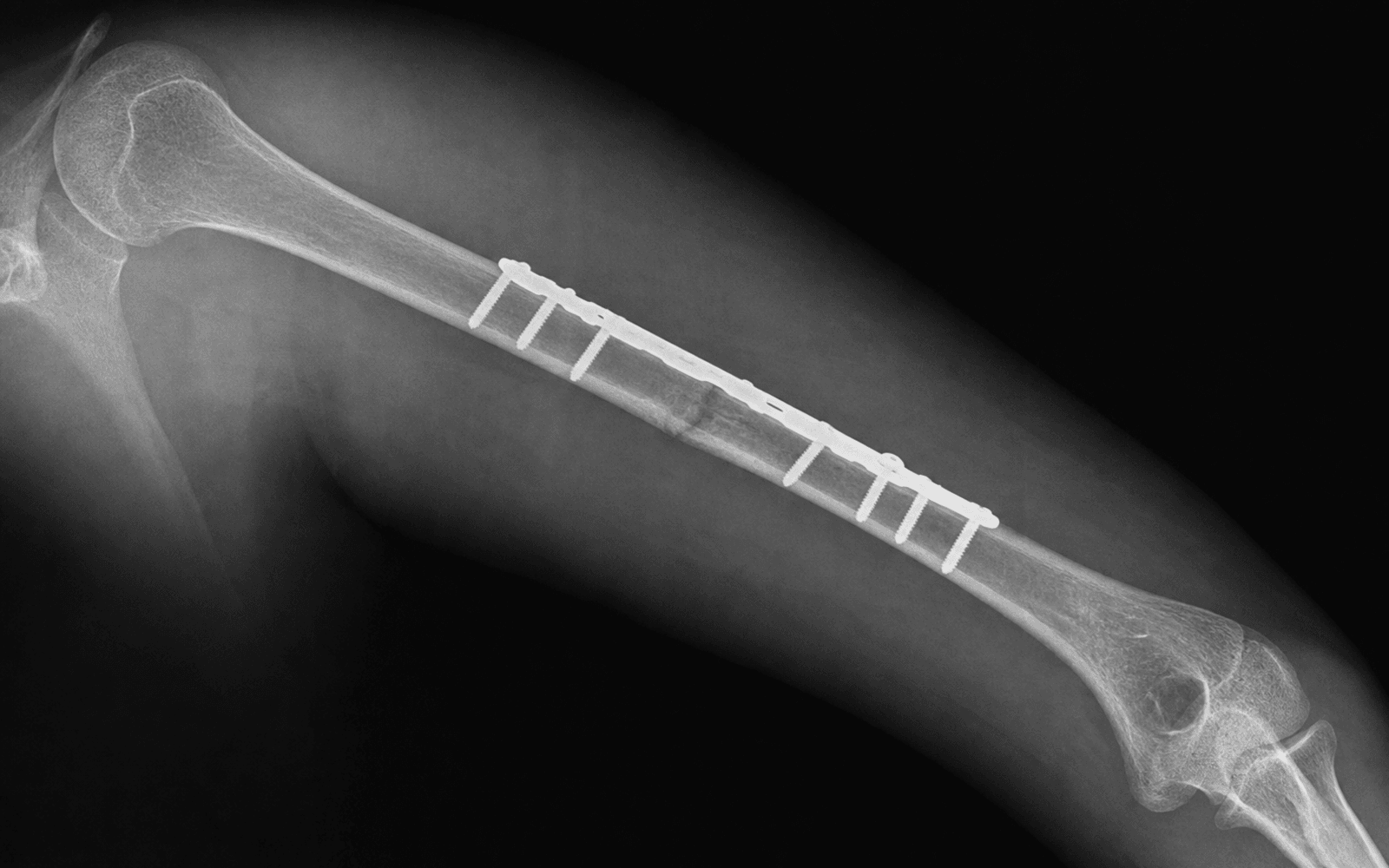Humeral shaft plating
