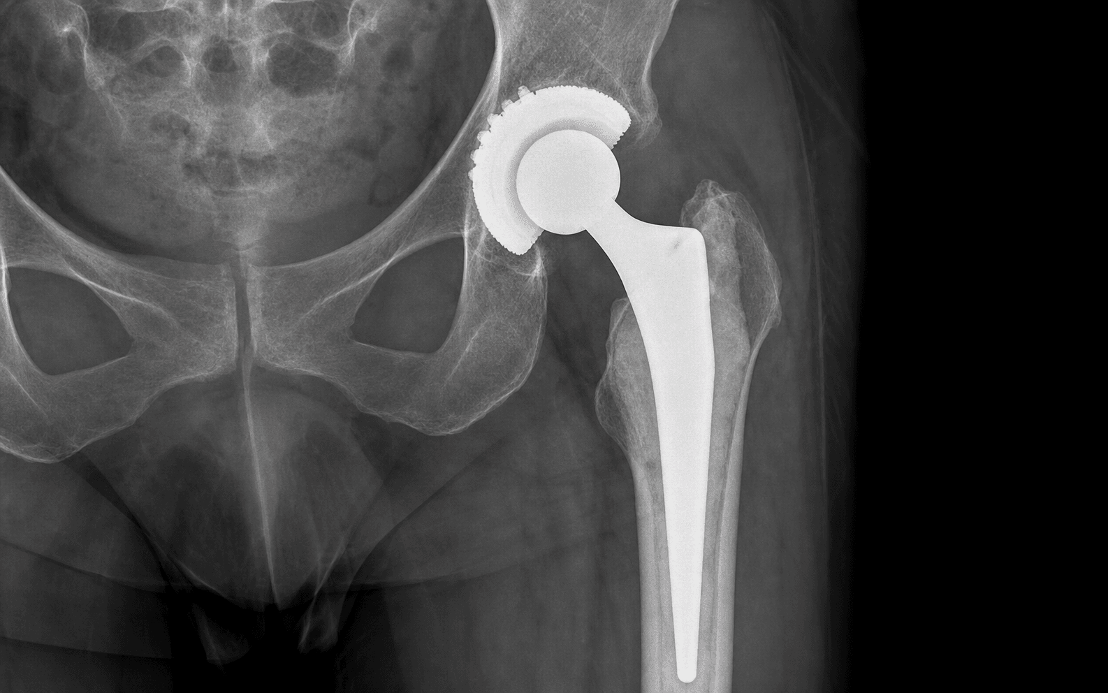 Hybrid total hip replacement