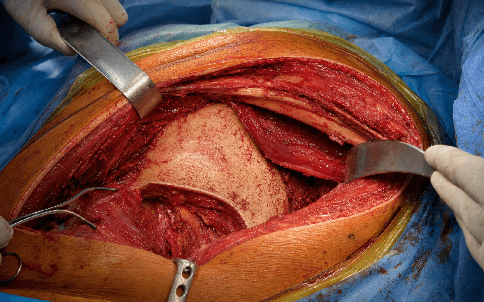 Iliac window exposure