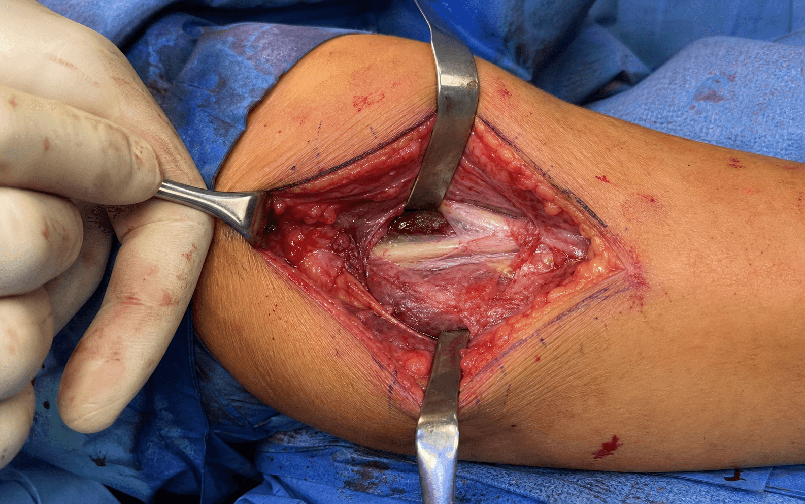 Kaplan lateral elbow approach