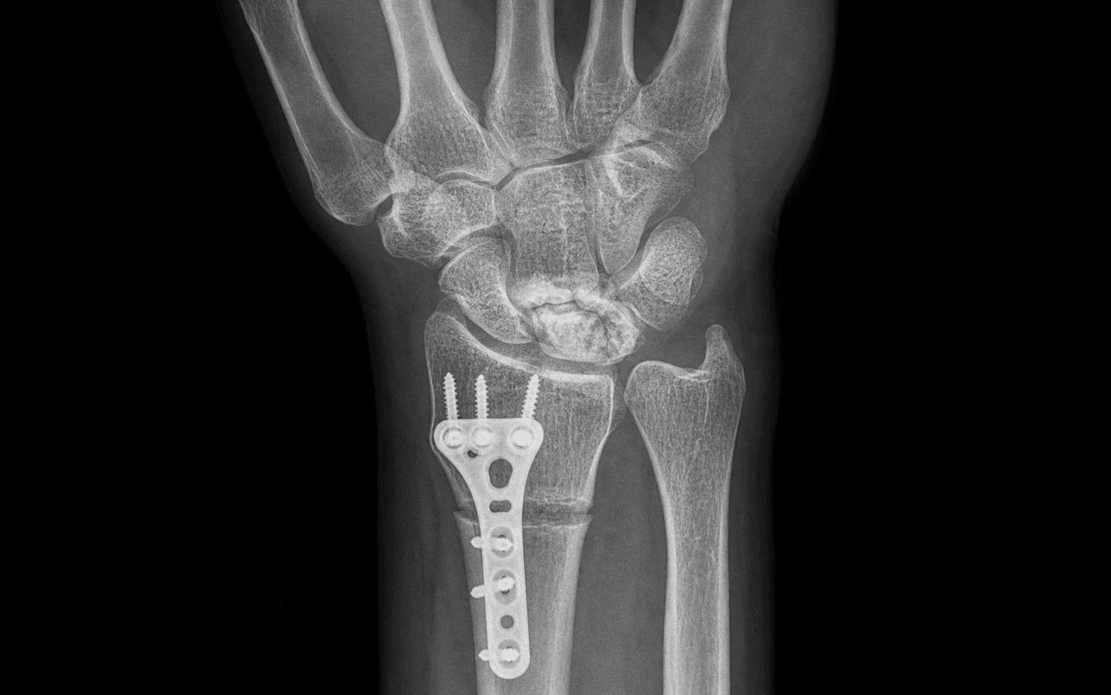 Radial shortening osteotomy for Kienbock disease