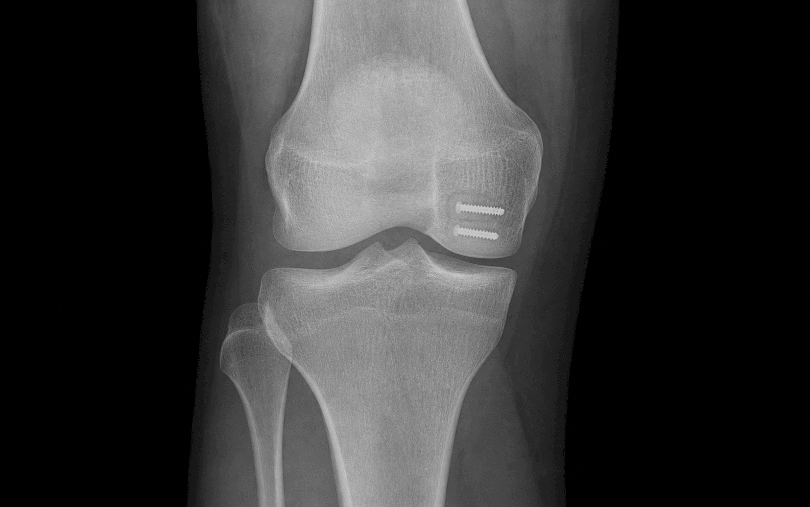 OCD medial femoral condyle screw fixation