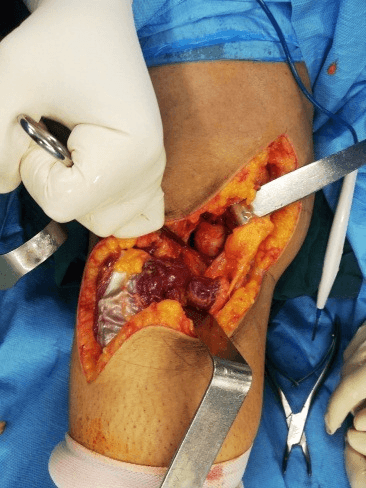 Open knee synovectomy field showing hypertrophic reddish-brown synovium in PVNS