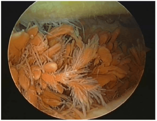 Arthroscopic view of hypertrophic villous synovial proliferation in knee PVNS