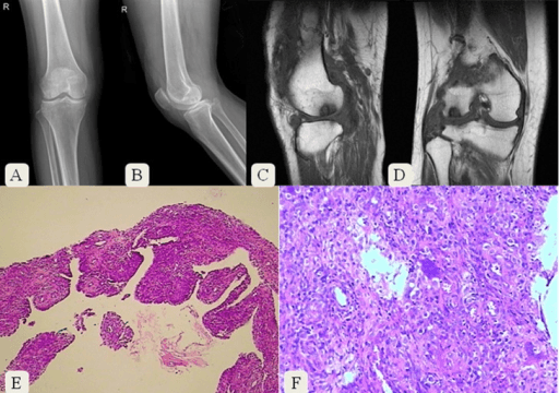 Six-panel PVNS case: radiographs, coronal MRI and histopathology of right knee