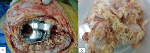 Intraoperative before and after synovectomy showing diffuse synovial papillae and excised specimen