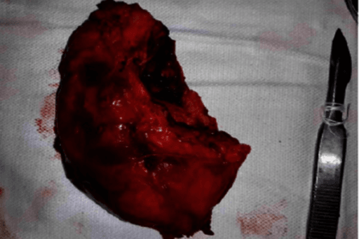 Excised PVNS synovectomy specimen — reddish-brown cystic-nodular mass with scalpel for scale