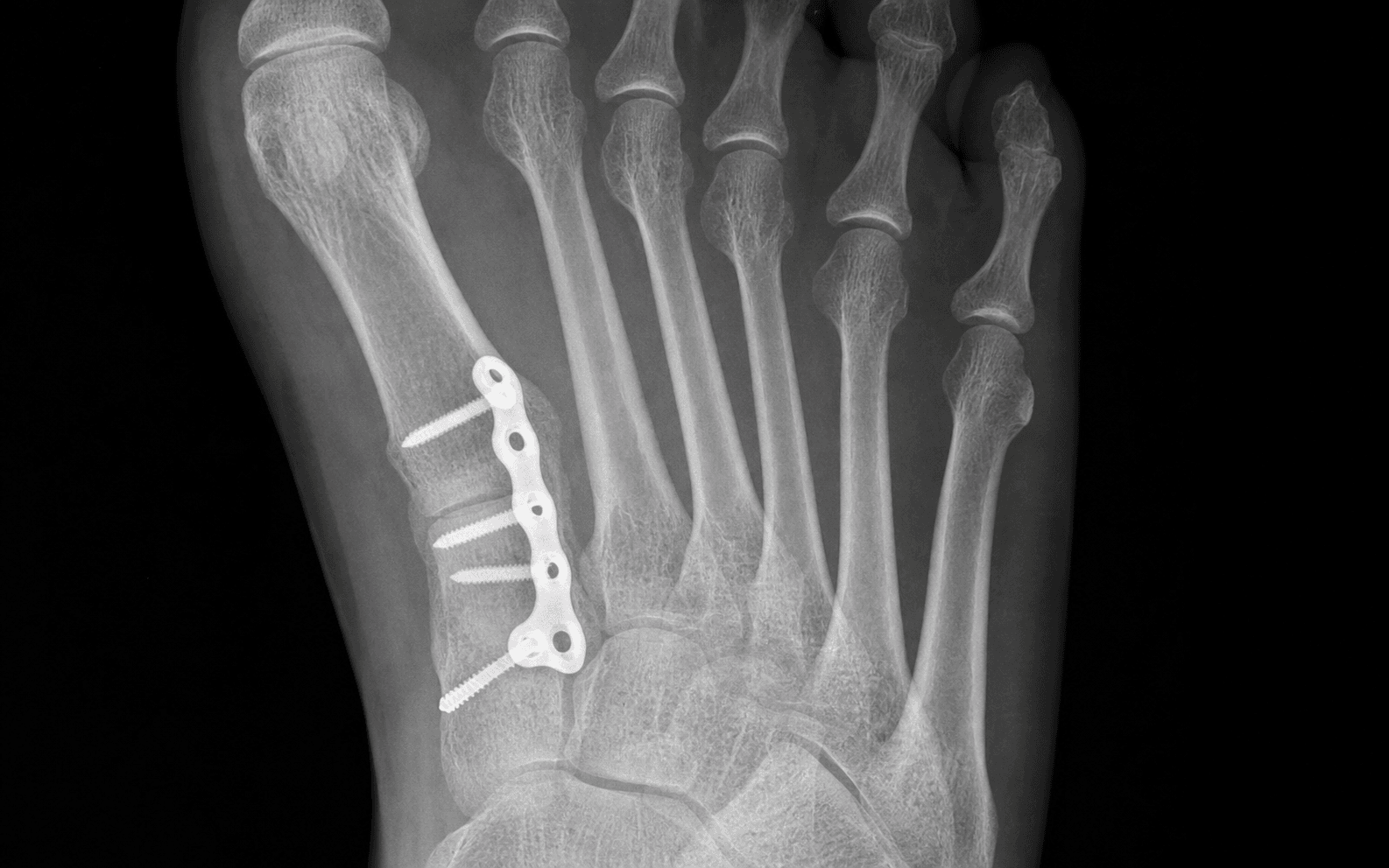 Lapidus 1st TMT arthrodesis