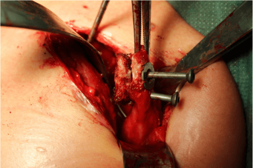 Intraoperative view of open Latarjet procedure showing coracoid graft positioning