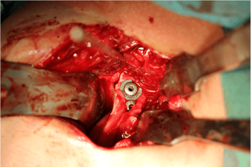 Intraoperative close-up showing two cortical screws securing the coracoid graft to the anterior glenoid