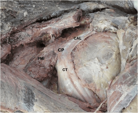 Cadaver dissection of coracoid region with labeled anatomy: TL trapezoid ligament, CAL coracoacromial ligament, CP coracoid process, PMI pectoralis minor insertion, CT conjoint tendon