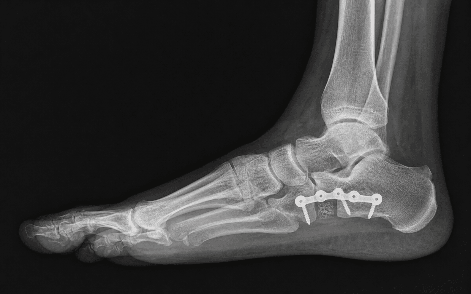 Lateral column lengthening