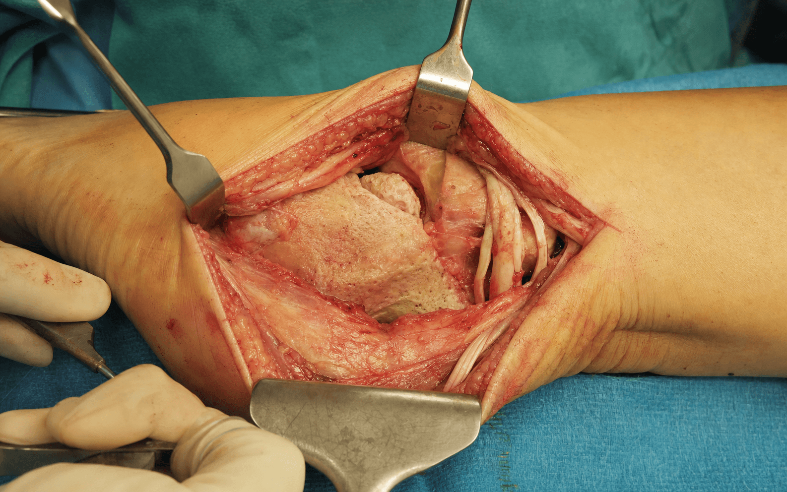Lateral extensile calcaneal approach