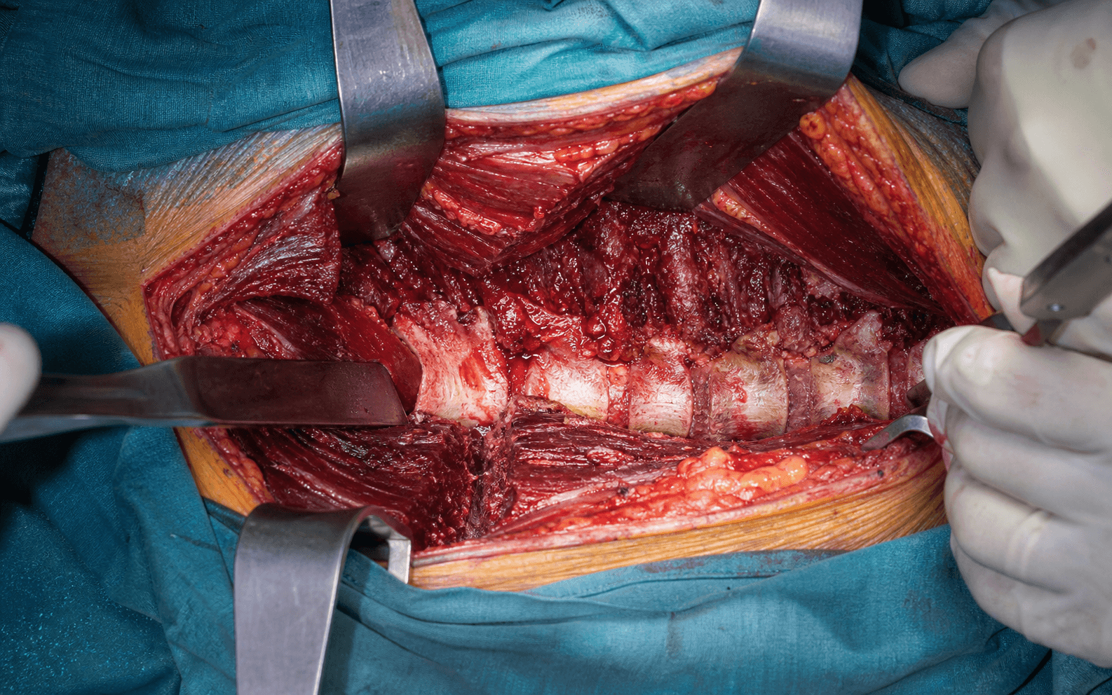 Lateral extracavitary spine approach