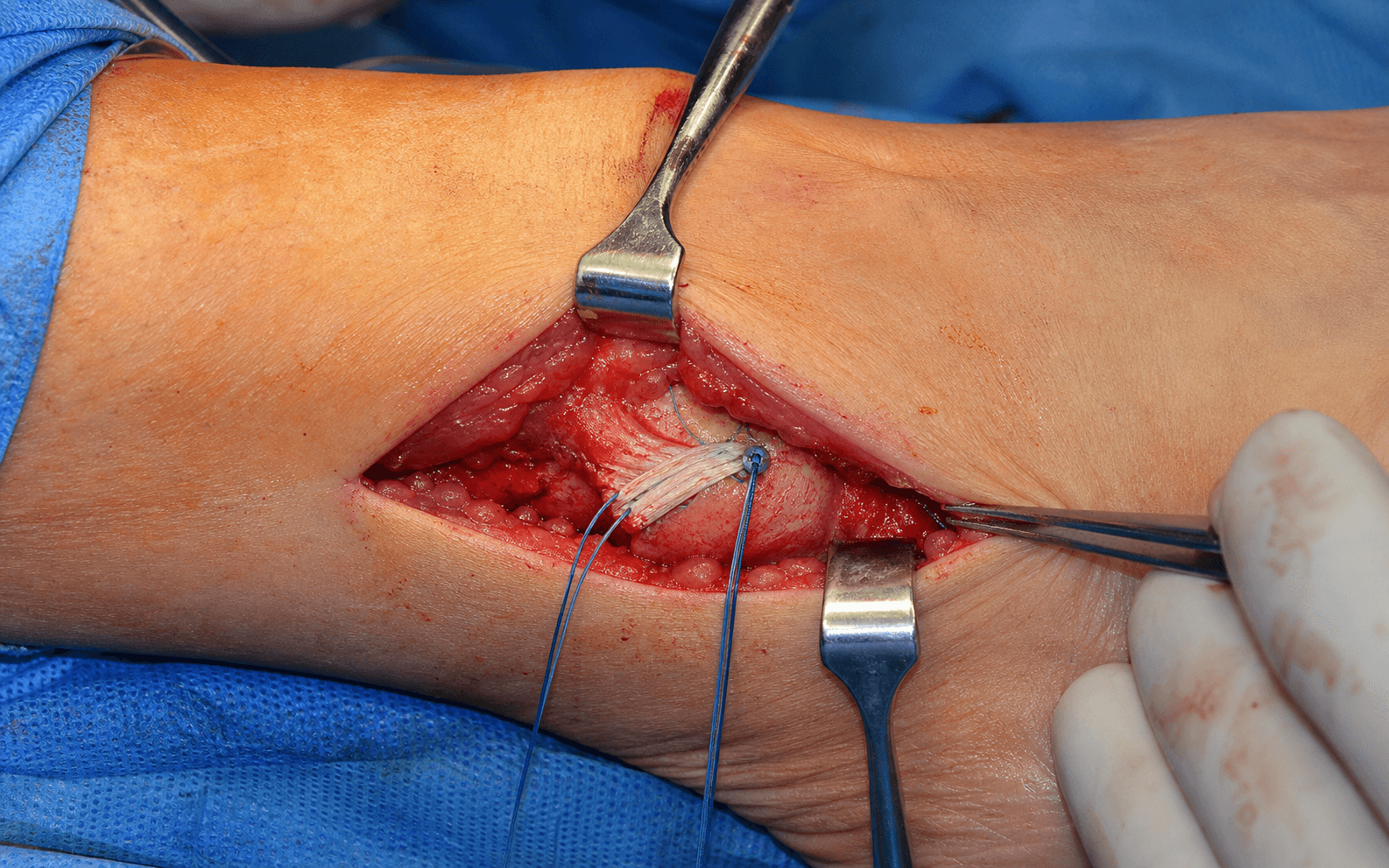 Brostrom lateral ligament repair