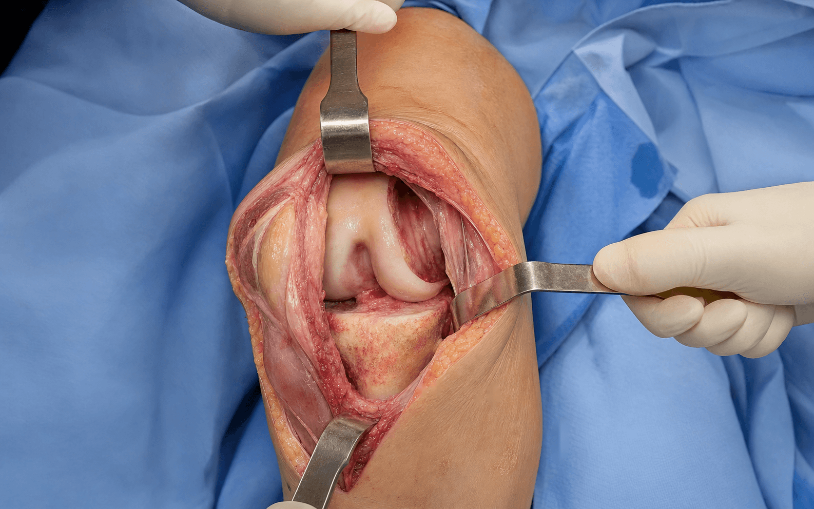 Lateral parapatellar arthrotomy