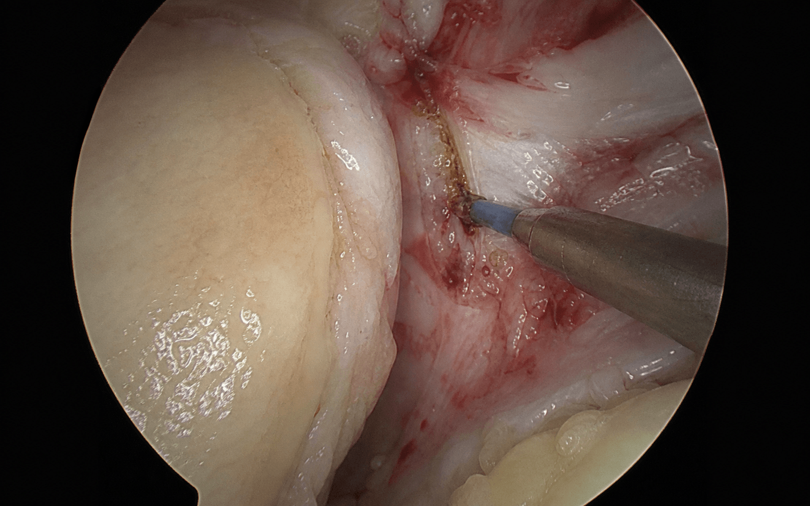 Arthroscopic lateral retinacular release