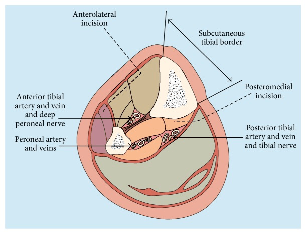 Cross-section diagram of the leg marking the anterolateral and posteromedial fasciotomy incisions relative to the tibia, fibula and neurovascular bundles
