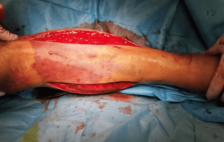 Lower leg after four-compartment fasciotomy with long open anterolateral and posteromedial wounds and exposed muscle