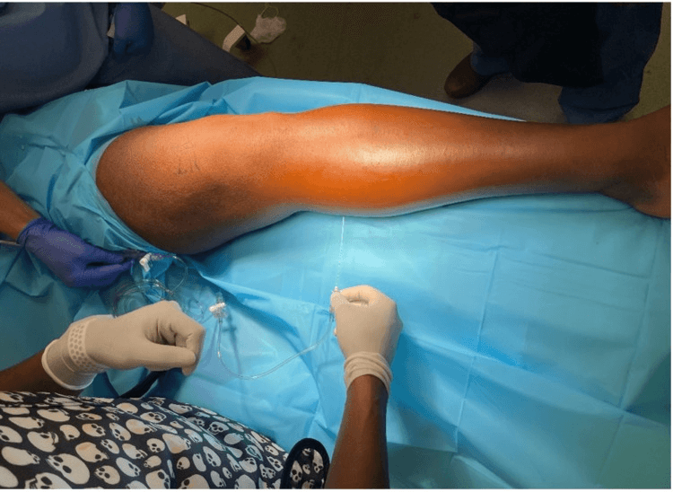 Needle and pressure tubing inserted into the calf of a swollen leg on a theatre drape for compartment pressure measurement