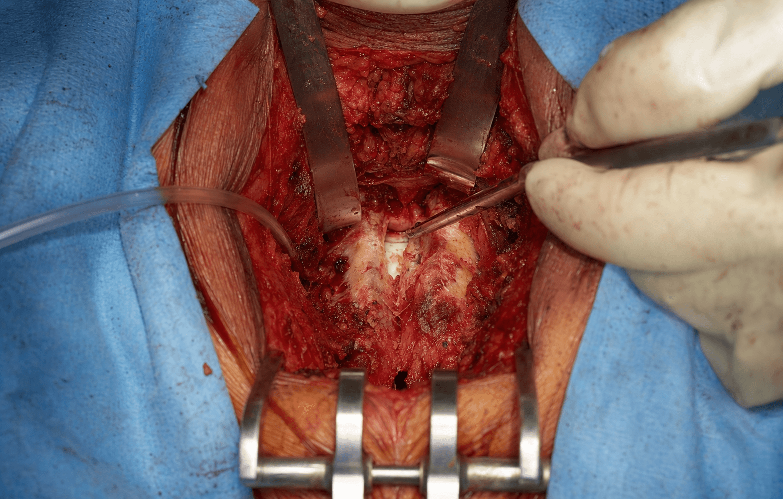 Lumbar decompression